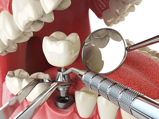Best Emergency Wisdom Tooth Extraction in Marbleton, WY